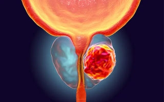 Tumore della prostata